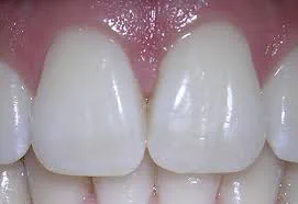 The Role of Incisors in Your Health: Why These Teeth Matter More Than You Think